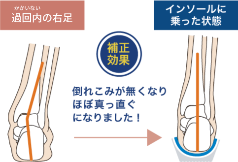 過回内の足とインソールに乗った足との比較