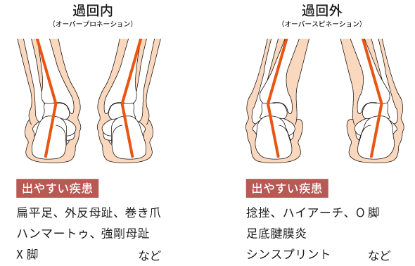 過回内についてのイメージ